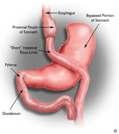 roux laparoscopic gastric bypass surgical procedure bariatric surgery